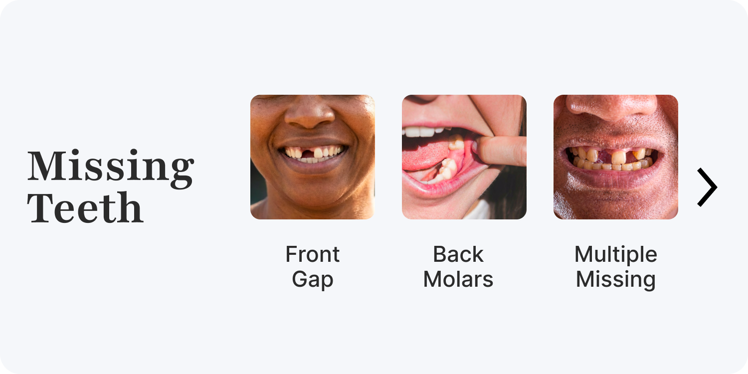 Missing Teeth